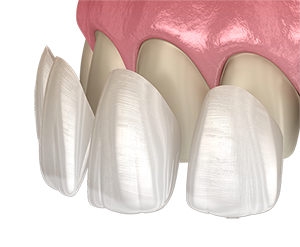 porcelain dental veneers in kitchener and cambridge